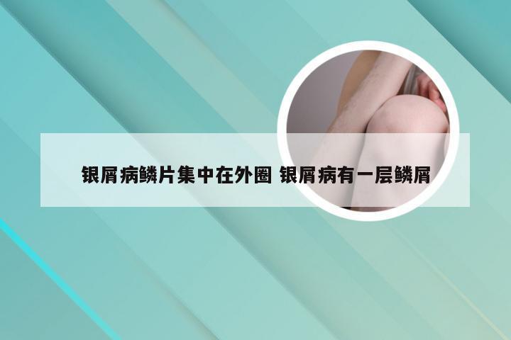 银屑病鳞片集中在外圈 银屑病有一层鳞屑