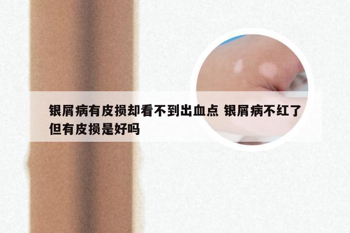 银屑病有皮损却看不到出血点 银屑病不红了但有皮损是好吗