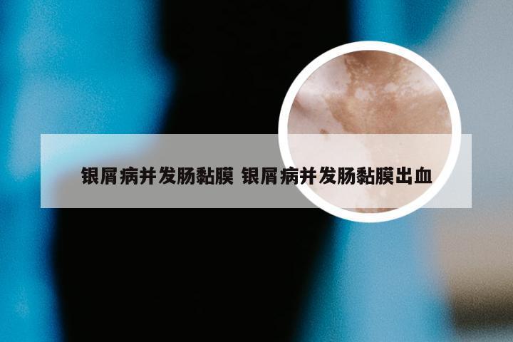 银屑病并发肠黏膜 银屑病并发肠黏膜出血