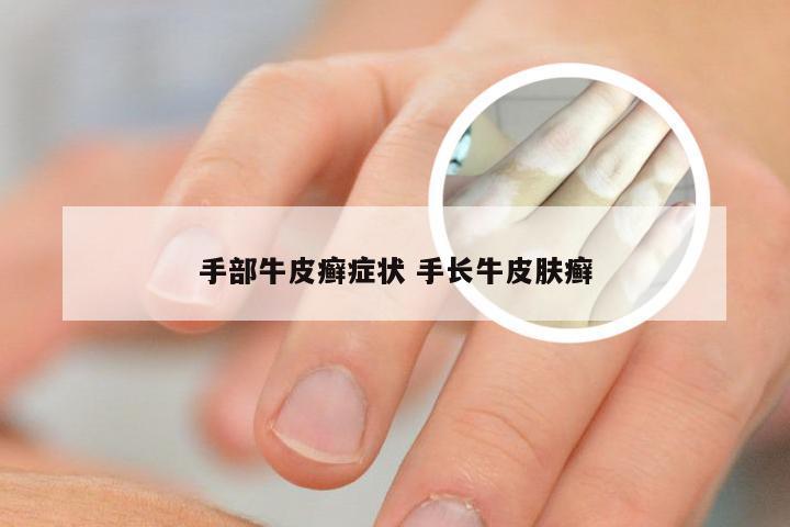 手部牛皮癣症状 手长牛皮肤癣