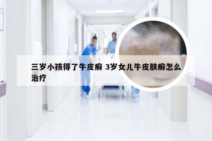 三岁小孩得了牛皮癣 3岁女儿牛皮肤癣怎么治疗