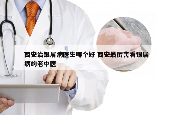 西安治银屑病医生哪个好 西安最厉害看银屑病的老中医
