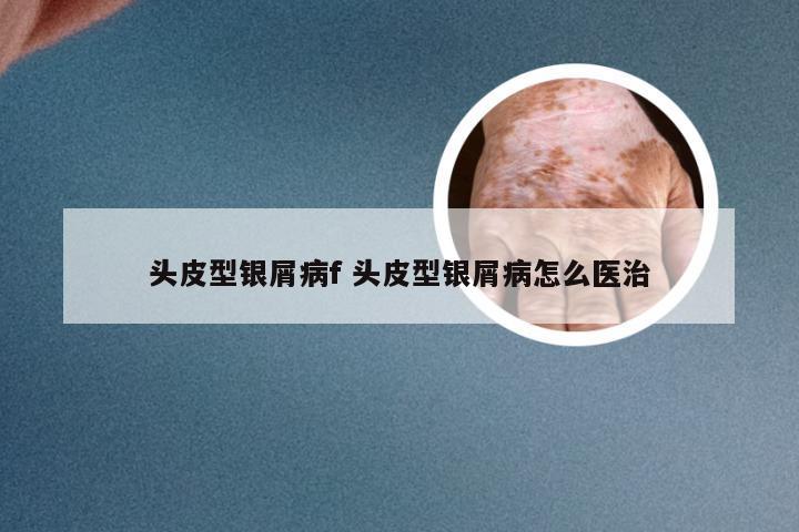 头皮型银屑病f 头皮型银屑病怎么医治
