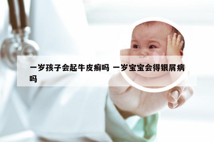 一岁孩子会起牛皮癣吗 一岁宝宝会得银屑病吗