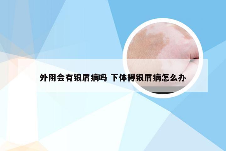 外阴会有银屑病吗 下体得银屑病怎么办