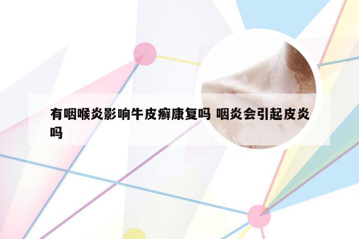 有咽喉炎影响牛皮癣康复吗 咽炎会引起皮炎吗
