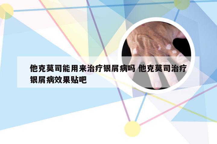 他克莫司能用来治疗银屑病吗 他克莫司治疗银屑病效果贴吧