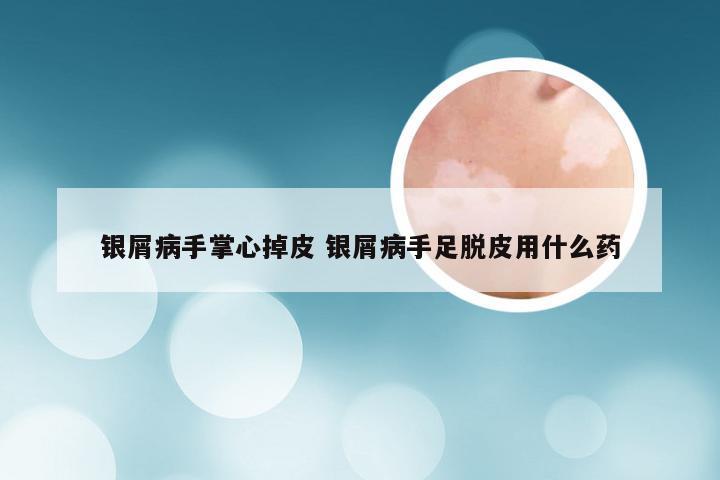 银屑病手掌心掉皮 银屑病手足脱皮用什么药