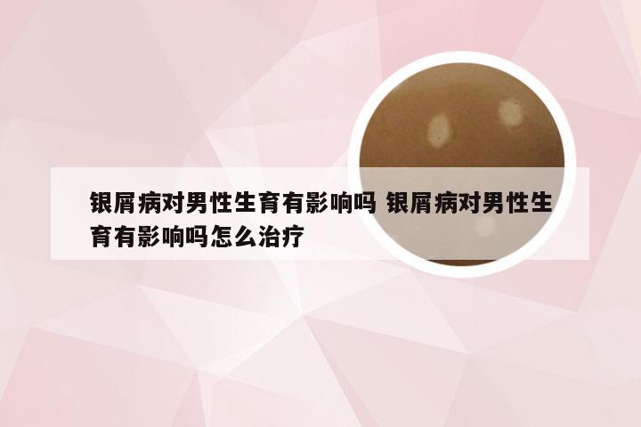 银屑病对男性生育有影响吗 银屑病对男性生育有影响吗怎么治疗