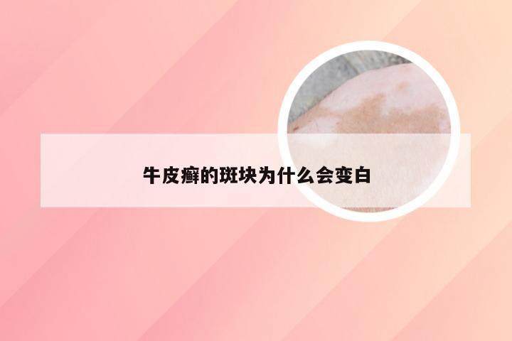 牛皮癣的斑块为什么会变白