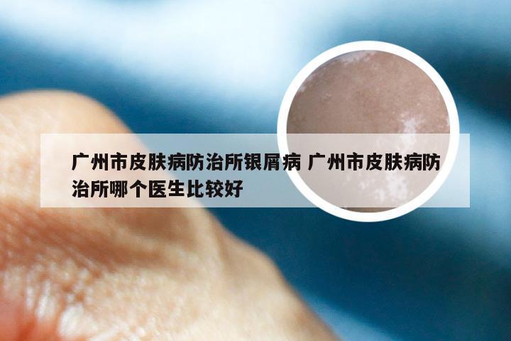 广州市皮肤病防治所银屑病 广州市皮肤病防治所哪个医生比较好