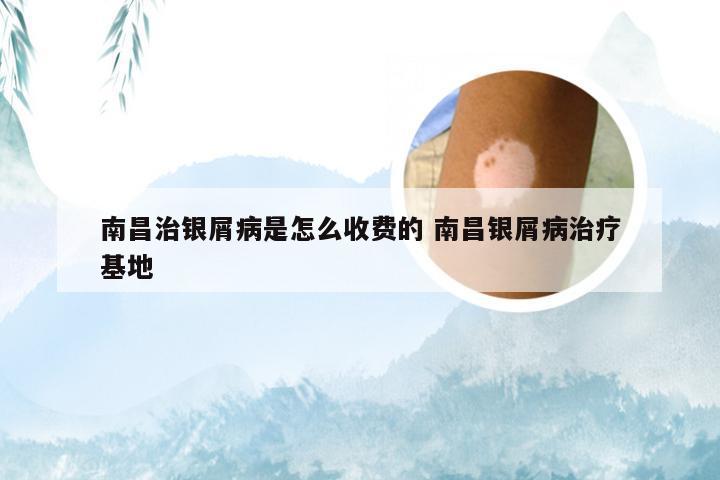 南昌治银屑病是怎么收费的 南昌银屑病治疗基地