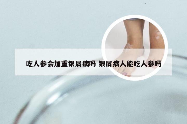 吃人参会加重银屑病吗 银屑病人能吃人参吗