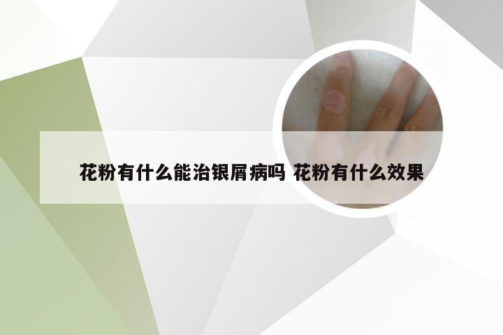 花粉有什么能治银屑病吗 花粉有什么效果