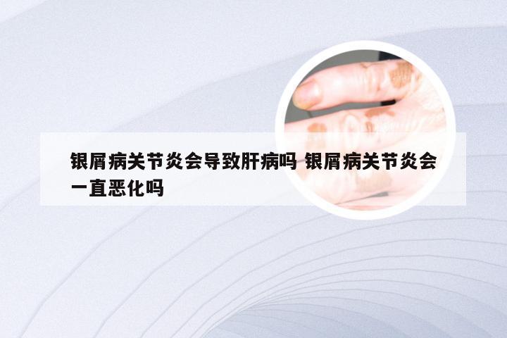 银屑病关节炎会导致肝病吗 银屑病关节炎会一直恶化吗