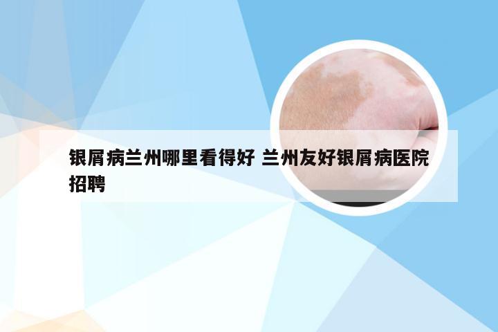 银屑病兰州哪里看得好 兰州友好银屑病医院招聘