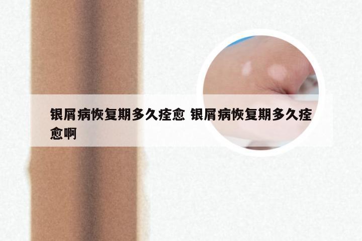 银屑病恢复期多久痊愈 银屑病恢复期多久痊愈啊