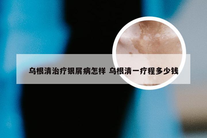 乌根清治疗银屑病怎样 乌根清一疗程多少钱