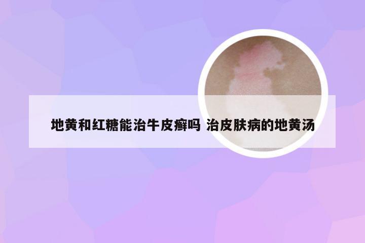 地黄和红糖能治牛皮癣吗 治皮肤病的地黄汤