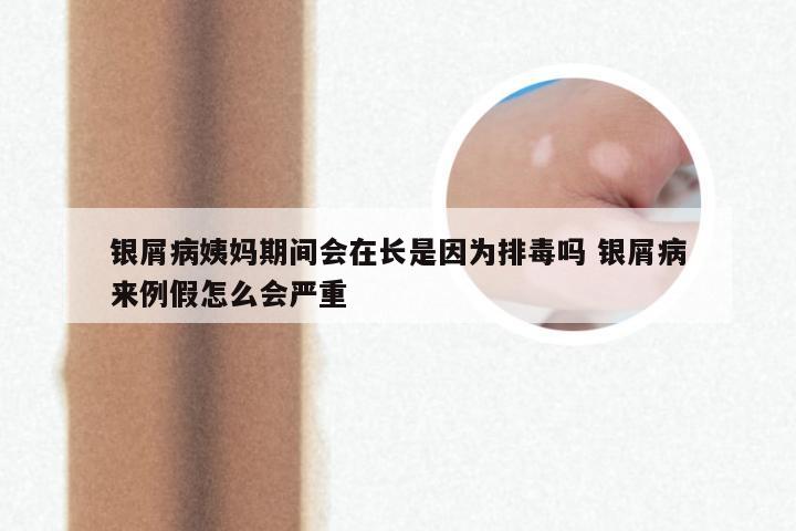 银屑病姨妈期间会在长是因为排毒吗 银屑病来例假怎么会严重