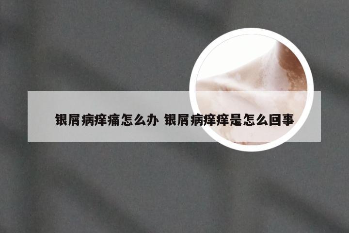 银屑病痒痛怎么办 银屑病痒痒是怎么回事