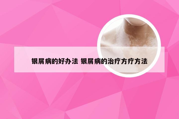 银屑病的好办法 银屑病的治疗方疗方法