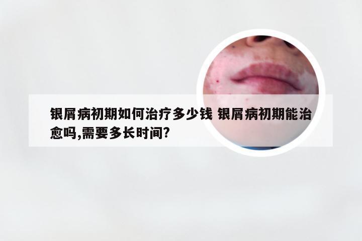 银屑病初期如何治疗多少钱 银屑病初期能治愈吗,需要多长时间?