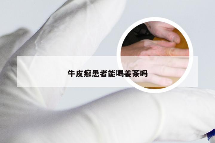 牛皮癣患者能喝姜茶吗