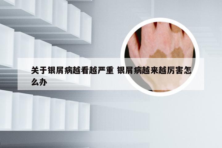 关于银屑病越看越严重 银屑病越来越厉害怎么办