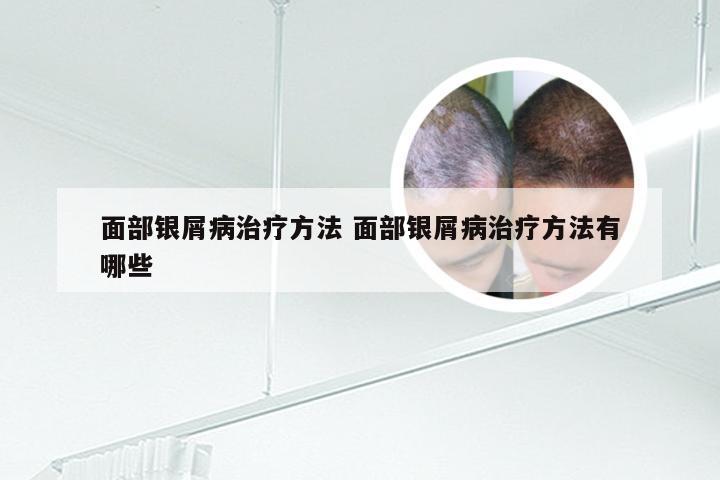 面部银屑病治疗方法 面部银屑病治疗方法有哪些
