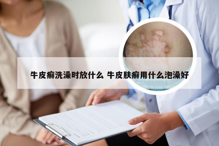 牛皮癣洗澡时放什么 牛皮肤癣用什么泡澡好