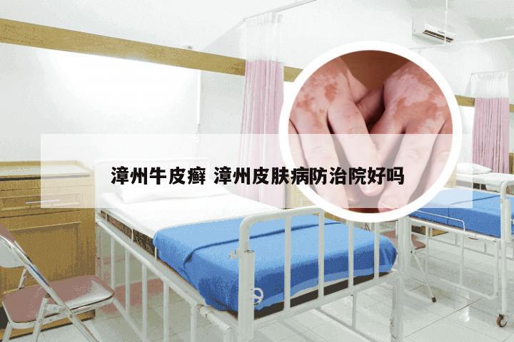 漳州牛皮癣 漳州皮肤病防治院好吗