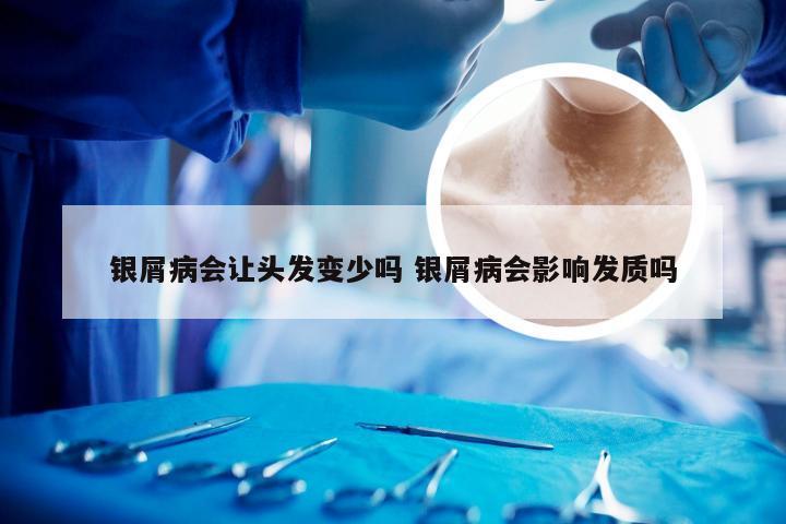 银屑病会让头发变少吗 银屑病会影响发质吗