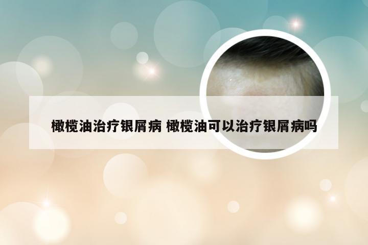 橄榄油治疗银屑病 橄榄油可以治疗银屑病吗