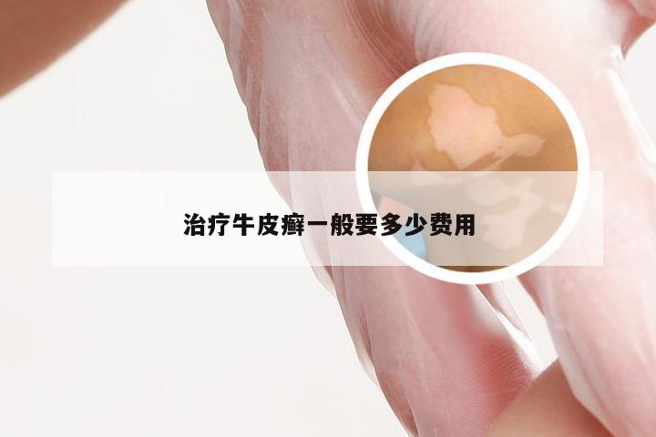 治疗牛皮癣一般要多少费用