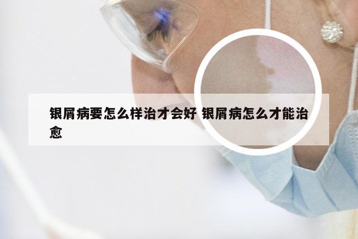 银屑病要怎么样治才会好 银屑病怎么才能治愈