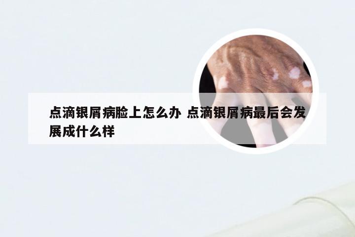 点滴银屑病脸上怎么办 点滴银屑病最后会发展成什么样