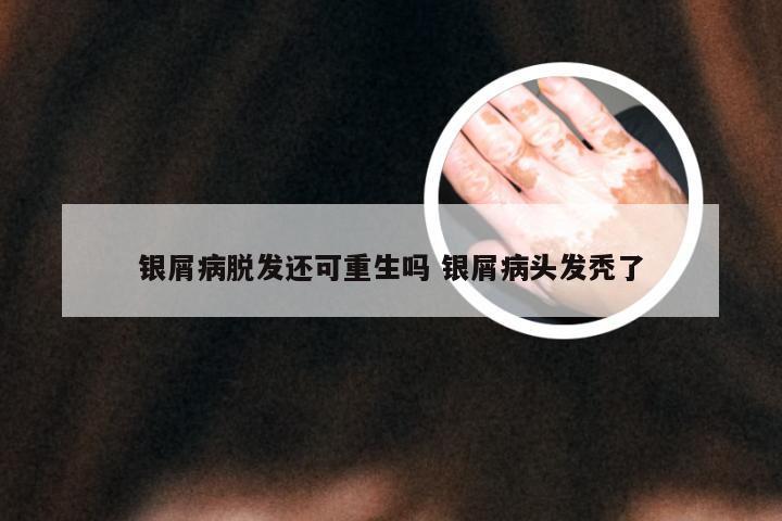 银屑病脱发还可重生吗 银屑病头发秃了