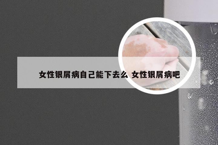 女性银屑病自己能下去么 女性银屑病吧