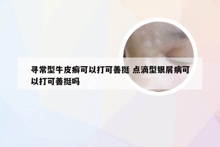 寻常型牛皮癣可以打可善挺 点滴型银屑病可以打可善挺吗