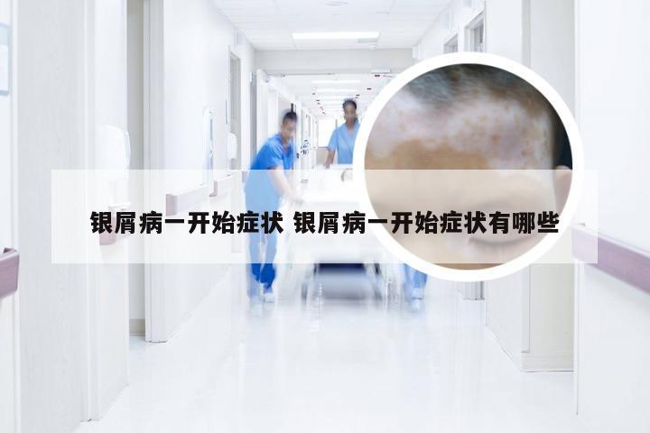 银屑病一开始症状 银屑病一开始症状有哪些