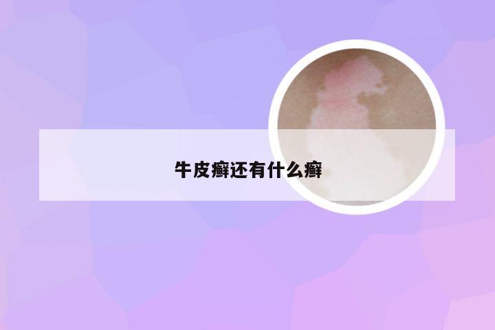 牛皮癣还有什么癣