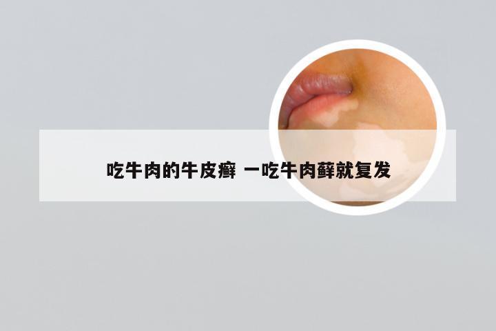 吃牛肉的牛皮癣 一吃牛肉藓就复发
