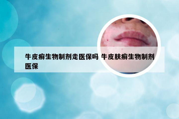 牛皮癣生物制剂走医保吗 牛皮肤癣生物制剂医保