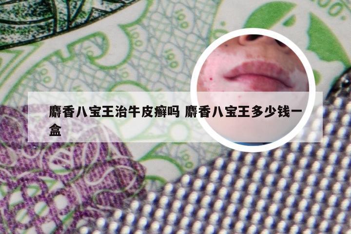 麝香八宝王治牛皮癣吗 麝香八宝王多少钱一盒