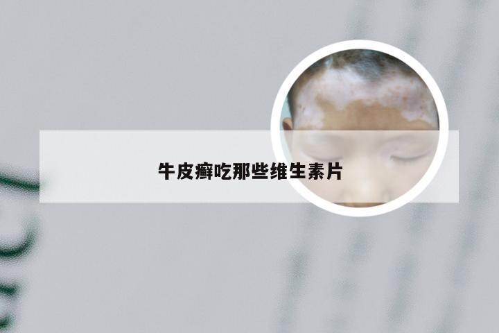 牛皮癣吃那些维生素片