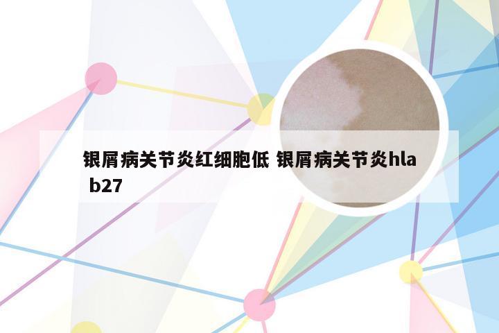 银屑病关节炎红细胞低 银屑病关节炎hla b27