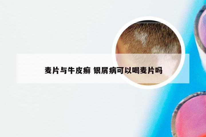 麦片与牛皮癣 银屑病可以喝麦片吗