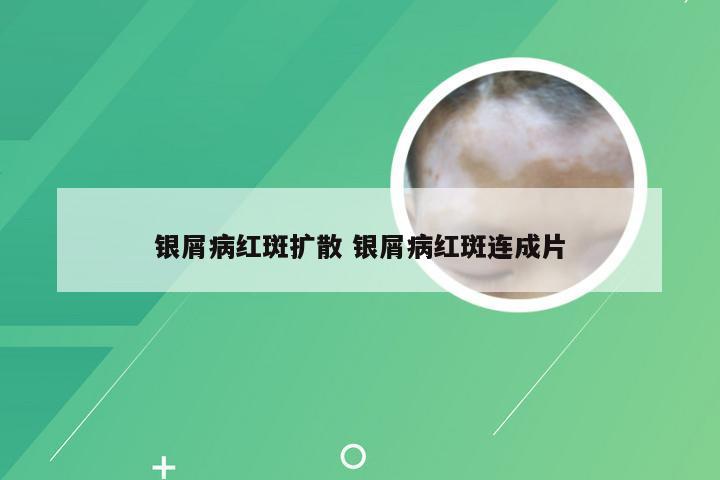 银屑病红斑扩散 银屑病红斑连成片