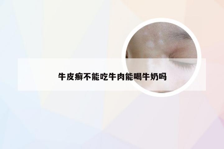 牛皮癣不能吃牛肉能喝牛奶吗